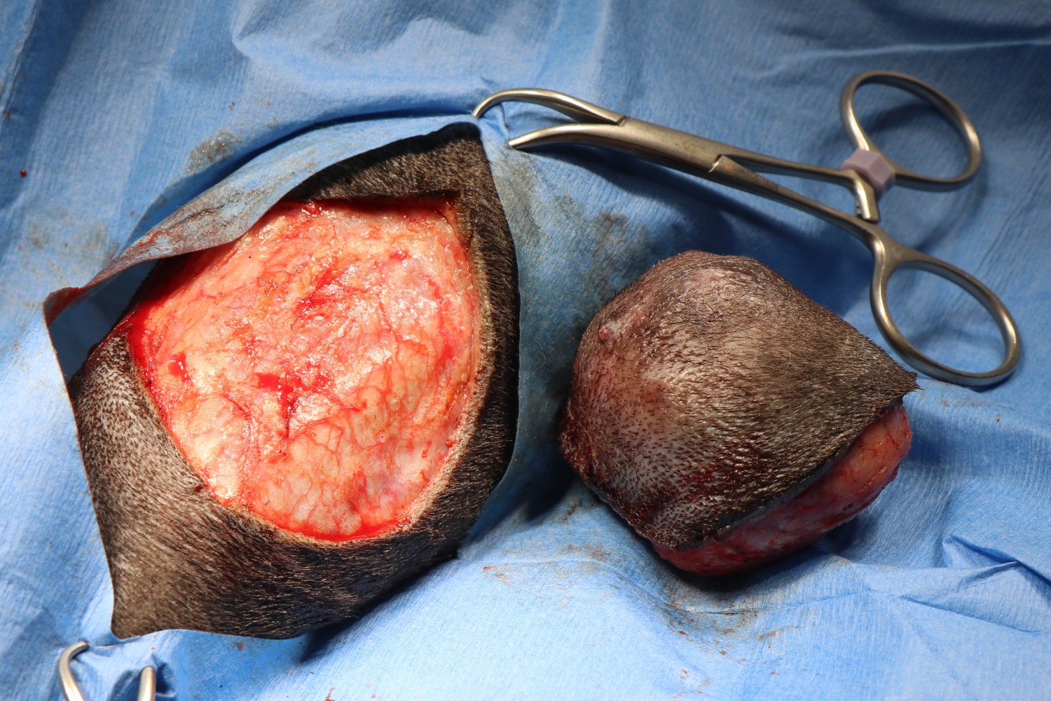 Mass / Tumor Removal